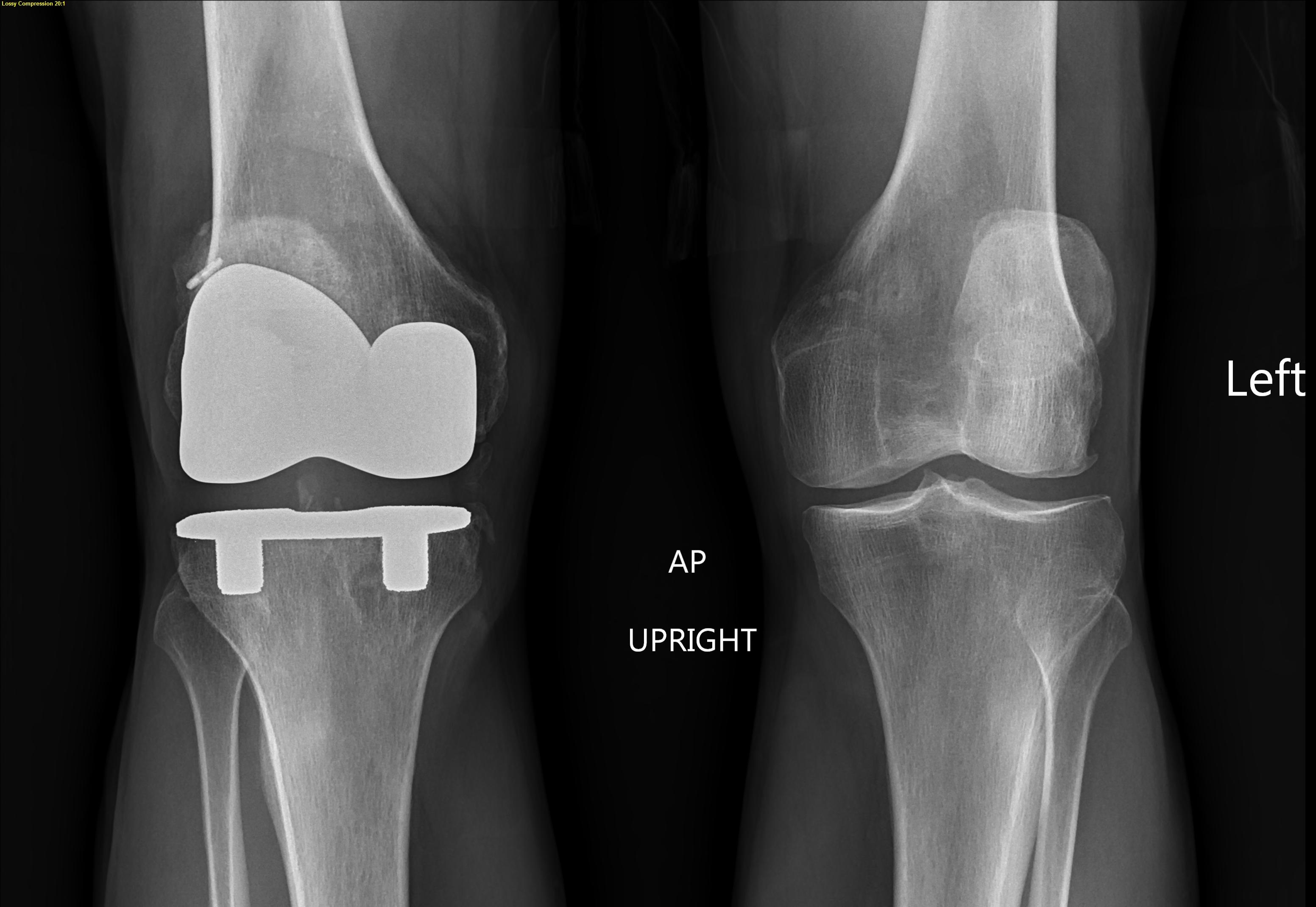 recovering-from-a-total-knee-replacement-bowen-hefley-orthopedics