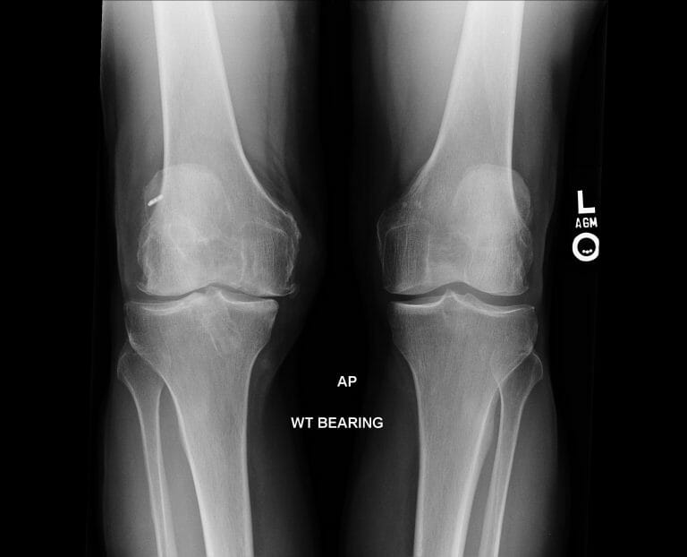 My New Knee: Running Again after a Total Knee Replacement | Uphill Athlete